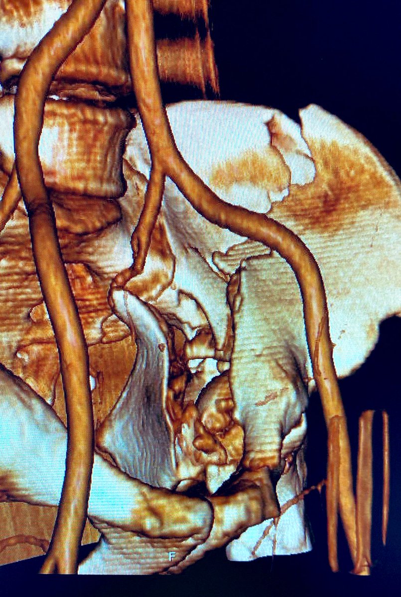 ✨Pleased to announce our fellowship post. ✨

Join our energetic team and work with us to gain skills in Pelvic, Acetabulum and hips surgery from the simple to most complex associated injuries. Gains MDT regional team MAPS interaction and work with revision surgeons. Candidates