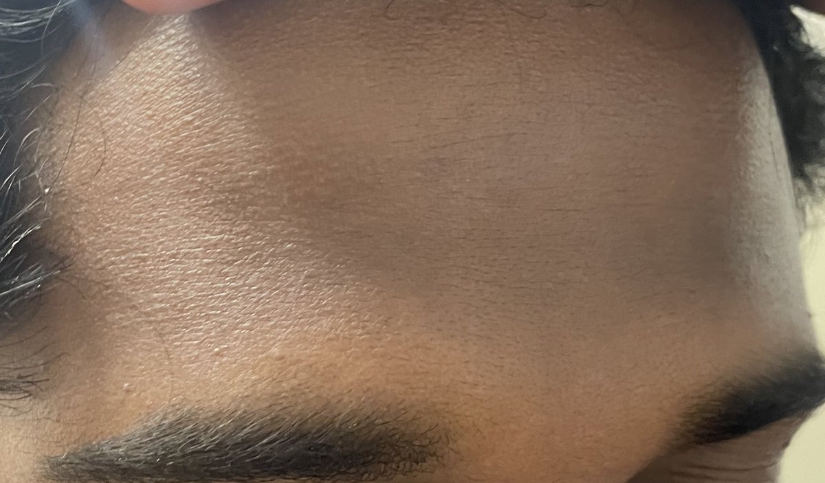 Had a patient who had started using 
Vit C serum on the advice of his fiancé for glowing skin before the wedding. Sadly he ended up with deeper pigmentation.

The problem was they didn’t think sunscreen needs to be used. 😕

Poor guy screwed himself and his dermat (me ☹️)