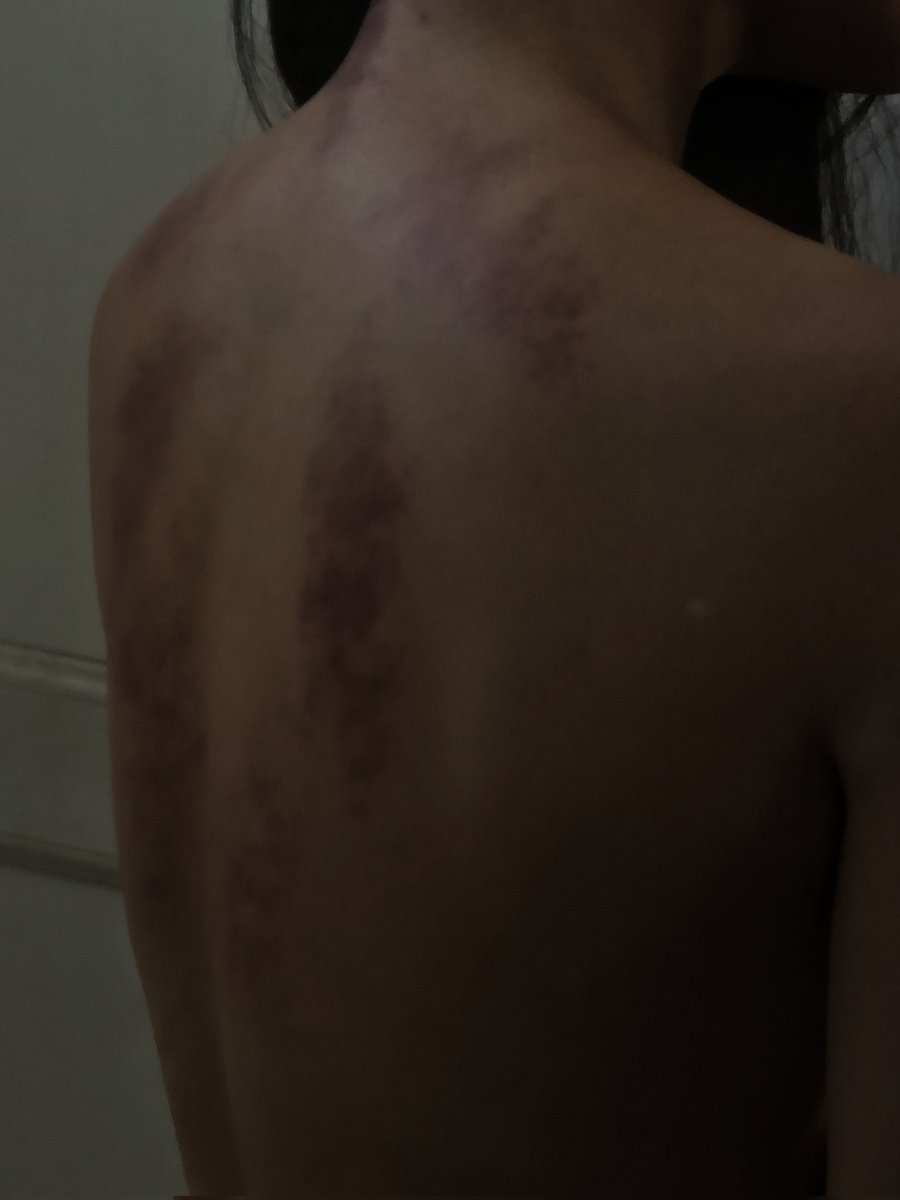 莫名有种美感 #淤青 #伤 #施虐