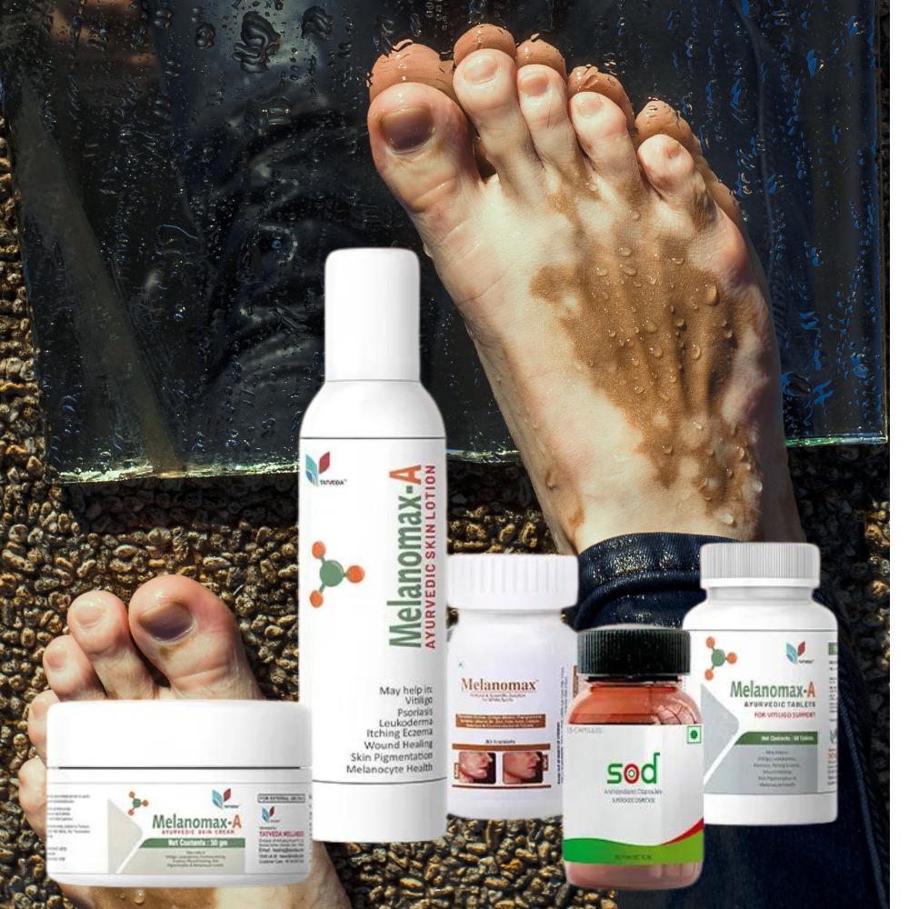 gleinmed's tweet image. Introducing Melanomax Collection for Vitiligo - A Scientific Natural Solution for White Spots. zurl.co/Opoy  Glein Pharma 9411471148
#gleinmed #Vitiligo #leucoderma #whitespots #Melanomax