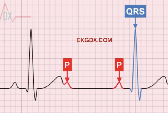 ekgdx's tweet photo. Let’s talk about 2:1 AV block. 

🔗👉 https://t.co/uHYXi7HYx5

#ekgdx #avblock #CardioTwitter https://t.co/JJ3mPkHNeK
