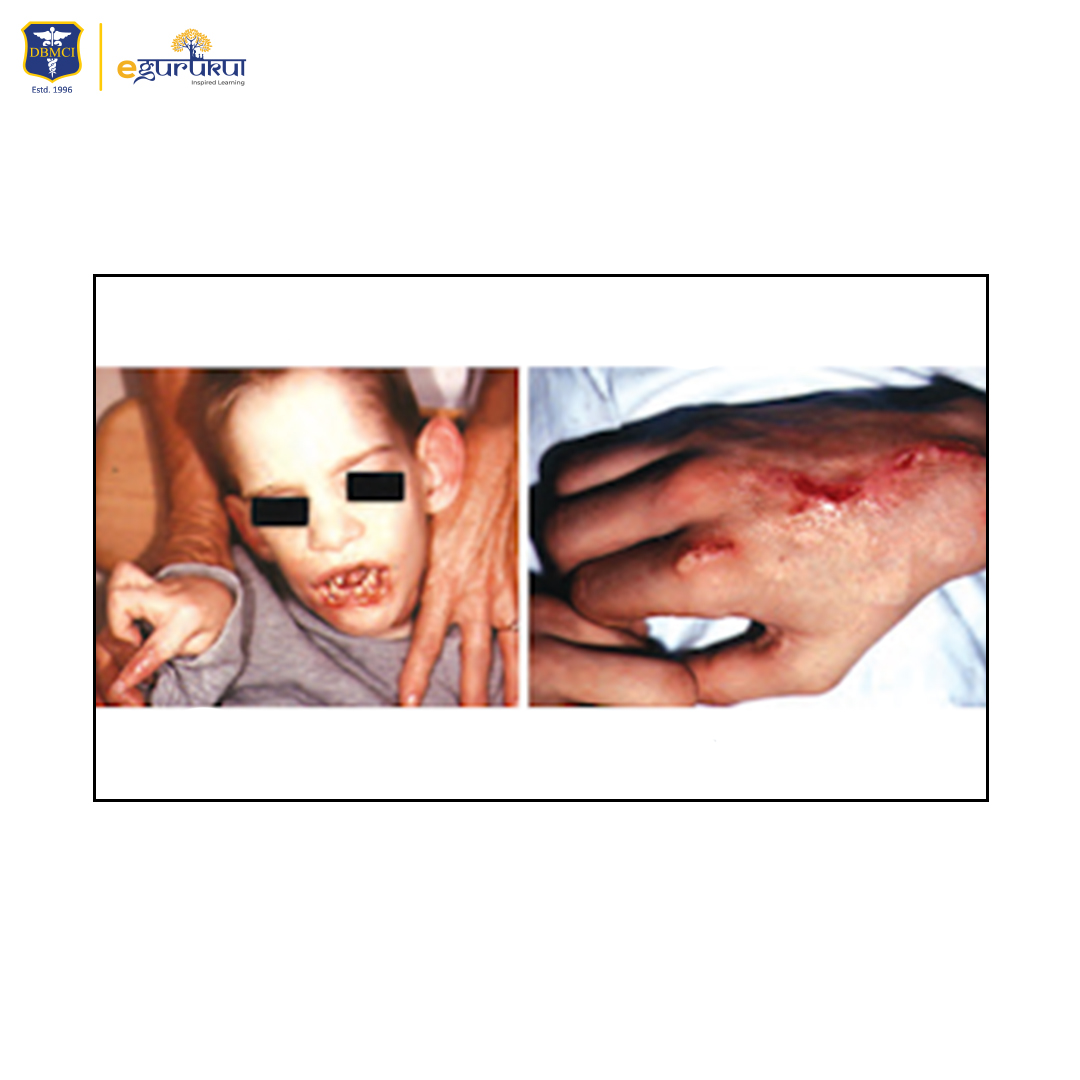 dbmci_official's tweet photo. Lesch-Nyhan syndrome is caused due to deficiency of which enzyme?
#MedX #Medicaleducation #medpg https://t.co/dNL4e2hi1I