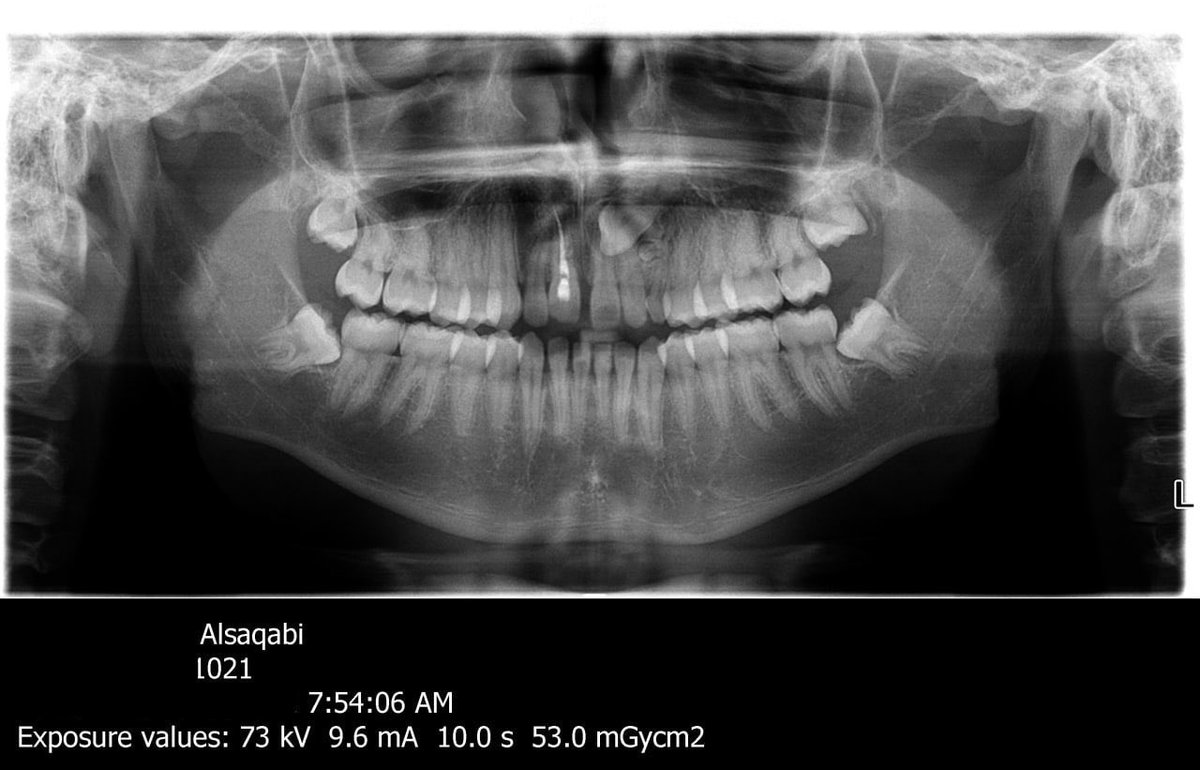 q8braces's tweet photo. #تغريدة #طبية للزملاء الأعزاء : حضر للعيادة عندي مع والدته قبل فترة، عمره ١٦ سنة ويشكي من #Impacted #Canine للأسف لم يتم إكتشاف السن الزائد بوقت مبكر، كان ممكن أن نتفادي #مشكلة الناب المطمور.

الفحص المبكر يجنب #الأطفال الكثير من المشاكل ..

#Supernumerary
#Tooth
#الكويت
#Kuwait https://t.co/eAhyGDBgva