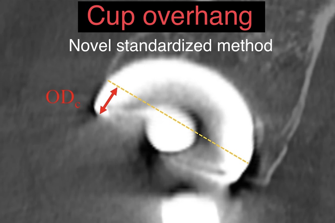 New #OpenAccess paper: #CupOverhang after THA 👉 link.springer.com/article/10.100… 👉 1) Robust standardized CT measurement 👉 2) Cup overhang is associated with iliopsoas impingement Marth A, et al. Eur Radiol 2023 Dec 26. doi: 10.1007/s00330-023-10479-5. @derbalgrist #MSKrad #Hip