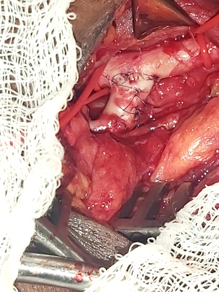 Dagim Leykun (@dagim_leykun) on Twitter photo Our latest #VascularSurgery <a href="/HawassaUniverst/">Hawassa University</a> Subclavian to Carotid transposition for Lt SCA origin complete occlusion presenting with Lt hand limb threatening ischemia. <a href="/gttefera/">Girma Tefera MD,FACS</a> Hey <a href="/farkomd/">frank arko</a> 👋 I have Moved another 'thing'...... #Reroute Our latest #VascularSurgery <a href="/HawassaUniverst/">Hawassa University</a> Subclavian to Carotid transposition for Lt SCA origin complete occlusion presenting with Lt hand limb threatening ischemia. <a href="/gttefera/">Girma Tefera MD,FACS</a> Hey <a href="/farkomd/">frank arko</a> 👋 I have Moved another 'thing'...... #Reroute