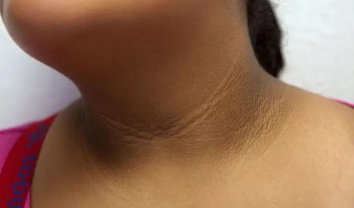 DoctorHumber's tweet photo. ¿Qué pensarías si ves estas manchas en el cuello? https://t.co/XagocfmLRc