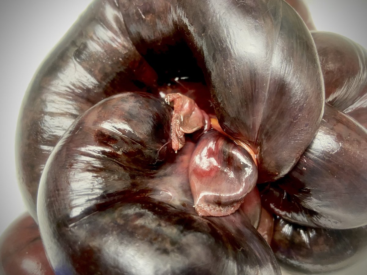 Today’s #GrossWordWednesday is a two-fer! This bowel is Tortuous:  snarled up; full of “twists and turns”. It is also Dusky, which is this lovely plum color that tissue becomes when its blood supply is cut off. 

#PathTwitter #MedTwitter #pathassist #pathresidents #pathresidency