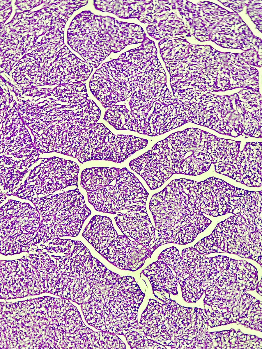 In the mind's eye, a ‘fractal’ is a way of seeing the infinity ! 

Thoughts ? 

#PathTwitter #Surgpath #impath
