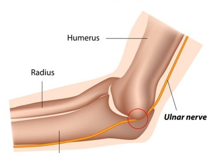 Dr. Patel may determine an ulnar nerve transposition is more appropriate than #ulnarnerve decompression. This is typically for severe cases, nerve instability, or revision (redo) surgeries. Learn more: medilink.us/2jvj  #sportsinjury #orthotwitter #elbowinjury