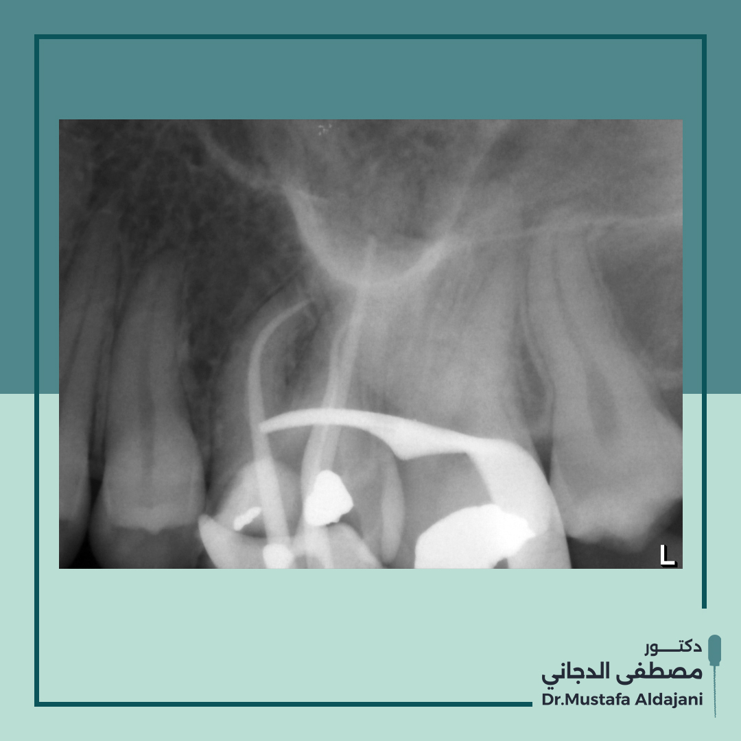 Draldajani's tweet photo. So, we decided to make a nonsurgical root canal retreatment. The case was quite difficult because there is duple curvature in the DB root, Alhamdulillah I did a great job.
Check the first post!!
#endodontist #denstis #x_rays https://t.co/26YKjXHUXn