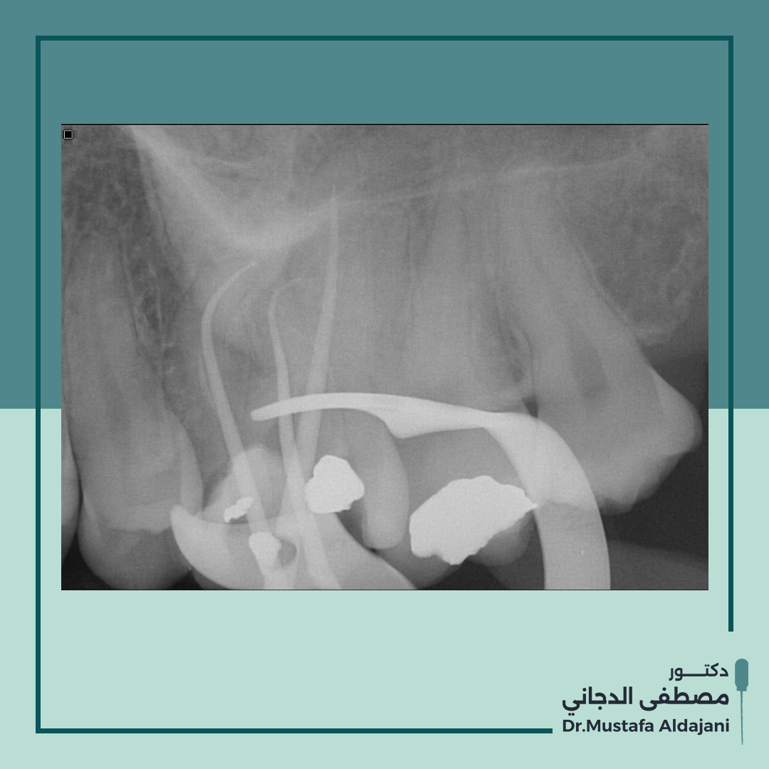 Draldajani's tweet photo. So, we decided to make a nonsurgical root canal retreatment. The case was quite difficult because there is duple curvature in the DB root, Alhamdulillah I did a great job.
Check the first post!!
#endodontist #denstis #x_rays https://t.co/26YKjXHUXn
