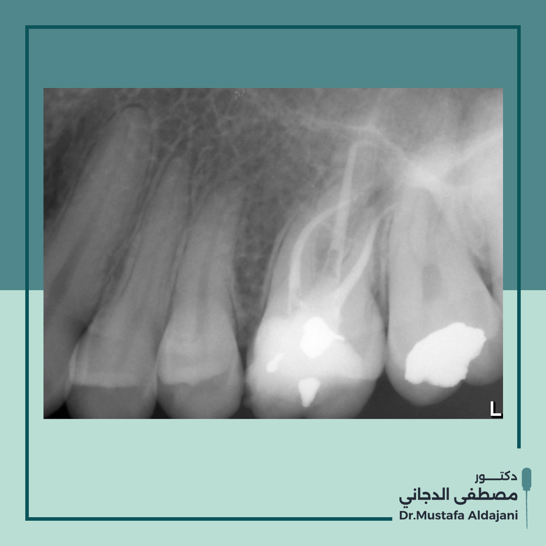 Draldajani's tweet photo. So, we decided to make a nonsurgical root canal retreatment. The case was quite difficult because there is duple curvature in the DB root, Alhamdulillah I did a great job.
Check the first post!!
#endodontist #denstis #x_rays https://t.co/26YKjXHUXn