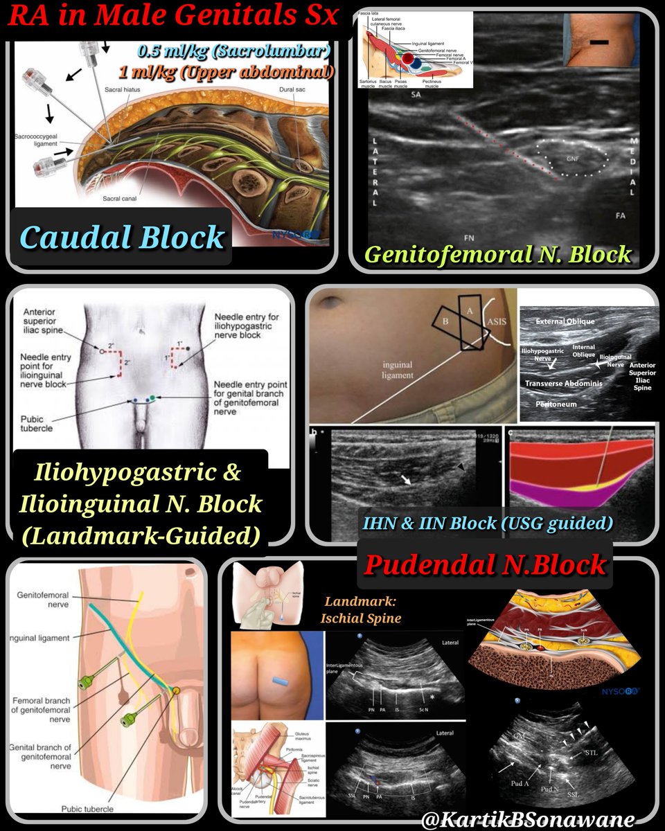 KartikBSonawane's tweet photo. "RA in Male genital Sx.:
Target spinal segments S2-S4 (for Penile Sx) & L1-L2 + S2-S4 (for Scrotal Sx)."
#RAingenitalsurgery #Penileblock #RAinpediatrics #RAinchildren #RAinscrotalsx #RAinUrogenitalSurgeries #pediatricRA
My 10 Points:
A. FUNCTIONAL ANATOMY:
1. PENIS is divided into 3 parts:
Root: Contains 3 erectile tissues (2 crura + 1 bulb) and 2 Ms. (Ishiocavernosus & Bulbospongiosus).
Body: Composed of 3 cylinders of erectile tissue: 2 corpora cavernosa and corpus spongiosum.
Glans: Most distal part, conical in shape, and formed by distal expansion of corpus spongiosum.
2. SCROTUM is pigmented external sac formed by skin + muscle that houses the testes, epididymis, and spermatic cord. The spermatic cord, a connective tissue matrix, contains vas deferens, 3 arteries, 3 veins, and 2 nerves. Third nerve (ilioinguinal N.) lies just lateral to the cord.
3. FASCIA:
Penile layers include -Skin, Superficial fascia (external fascia of Colles) is a continuation of Scarpa fascia; deep fascia (Buck’s fascia) is a continuation of deep perineal fascia, and Tunica albuginea (under Buck’s facia) forms an individual capsule around each cavernous body.
Scrotal layers include- Skin, superficial (Dartos) fascia, external spermatic fascia, cremaster muscle, internal spermatic fascia, and tunica vaginalis.
B. INNERVATIONS:
4. Penis: S2-S4 segments.
Sensory & Sympathetic innervation (skin + glans) Penis: Pudendal N. through Dorsal nerve of the penis (DNP) + Perineal nerves.
Encapsulated somatosensory receptors (mechanoreceptors/nociceptors) are present in prepuce.
Glans is innervated by free nerve endings and has protopathic sensitivity.
Parasympathetic: From the cavernous nerves from the peri-prostatic nerve plexus.
5. Scrotum & Testis: L1-L2 and S2-S4 (through IHG, IIN, GFN, and pudendal N).
Somatosensory: Anterolateral surface - Genital br. of GFN. Anterior surface - Anterior scrotal Ns. (br. of the IIN), Posterior surface- Posterior scrotal Ns. (from perineal N.), Inferior surface - Long scrotal br. (of PFCN).
Autonomic: Testes embryologically derived from the same level as the kidneys, so share common autonomic innervation.
90% Sympathetic from T10-L1 segments and 10% Parasympathetic from S2-S4.
Autonomic nerves (3 groups):
Superior spermatic Ns. (from renal & intermesenteric plexuses), Middle spermatic Ns. (from superior hypogastric plexus), Inferior spermatic Ns. (from inferior hypogastric plexus).
6. MYOTOMES:
Penile muscles (2 Bulbospongiosus + 2 Ishiocavernosus) : Deep branch of the perineal N. (branch of pudendal N).
Scrotal muscles (Dartos and Cremaster): Sympathetic and somatic fibres of the genital branch of GFN.
C. RA TECHNIQUES:
Target segments:
S2-S4: For all penile surgeries (Circumcision, hypospadias, urethroplasty, etc).
L1-L2, S2-S4: For all scrotal surgeries (Orchipexy, testis Sx, TURP etc)
7. Available RA techniques:
Caudal anesthesia -0.25-0.5 ml/kg LA volume (Lumbosacral segments). Associated with tachycardia, motor block of LL, and vomiting.
Topical analgesia using Lidocaine/Lidocaine + prilocaine.
Ring block – For analgesia. 8% failure rate, bleeding, and edema.
Penile block: Landmark-guided associated with swelling, hematoma/edema, or bruising. Ultrasound-guided is relatively safer.
8. Penile block (Landmark-guided):
Subpubic approach. Landmarks: Pubic symphysis & inferior border of the pubic rami.
2 needle entry points on lateral side of pubic symphysis, just below the pubic ramus (0.5 cm for babies and 1 cm for older boys).
Needle direction: Slightly medial & caudal direction (10-15 degrees to the vertical axis).
LA deposited- after a“POP” as the needle penetrates
Scarpas Fascia and enters into the subpubic space.
Coverage: DNP.
Sparing: Ventral penis, especially frenulum.
9. Penile block (USG-guided):
Probe kept transversely at the base of the penis between the shaft and the scrotum.
Sonoanatomy: Corpora cavernosa identified. Dorsal arteries, dorsal nerves, and dorsal vein are located beneath the deep fascia of the penis (Buck’s Fascia).
Standard 2-inj technique: LA injected laterally (0.1 ml/kg) to the penile A. inside Buck’s Fascia on each side.
Modified (by Suleman et al.) single inj. technique:
Needle: In-plane approach entering from the right side. After negative aspiration 0.15-0.25 ml/kg LA injected within the fascia around right DNP.
Needle slightly retracted under the corpora cavernosa. A 1-2 ml of LA deposited on the median line.
Needle was advanced towards the contralateral nerves and LA deposited under the fascia to block left DNP.
Advantage: Single entry needle with bilateral anesthesia of DNP + ventral glans. Circumferential spread of LA with anesthesia of the entire penis.
10. Supplementary RA techniques:
a) Ring block of penis:
Same cutaneous puncture as the dorsal block. Needle can be fanned out subcutaneously to the 3 and 9 o’clock position and then by repositioning the needle to these position to subcutaneous involve 6 o’clock/scrotal area.
b) Ilioinguinal + iliohypogastric nerves block:
Landmark-guided - Needle entry point 2cm medial and 2cm superior to the ASIS.
USG-guided: Probe is Kept obliquely on a line joining ASIS with umbilicus. Both nerves can be located between IOM-TAM with pulsating DCA adjacent to them.
c) Pudendal nerve block:
Landmark/PNS-guided- With the patient in the lithotomy, the ischial spine is palpated via transrectal (male) or transvaginal (female). LA deposition- Posterior to the ischial spine at the attachment of sacro-spinous ligament.
Ultrasound-guided: Pt in lateral decubitus position. Probe (curvilinear): Kept on the midpoint of the line connecting GT and PSIS. Sonoanatomy: Continuous hyperechoic line - iliac bone. The probe moved parallel and caudal to the lesser sciatic notch. Needle: 80-120 mm needle inserted in-plane from lateral-to-medial direction until tip located close to the pudendal A. Pudendal N. stimulation - Paresthesia in the perineum. LA volume: 15-20 ml LA.