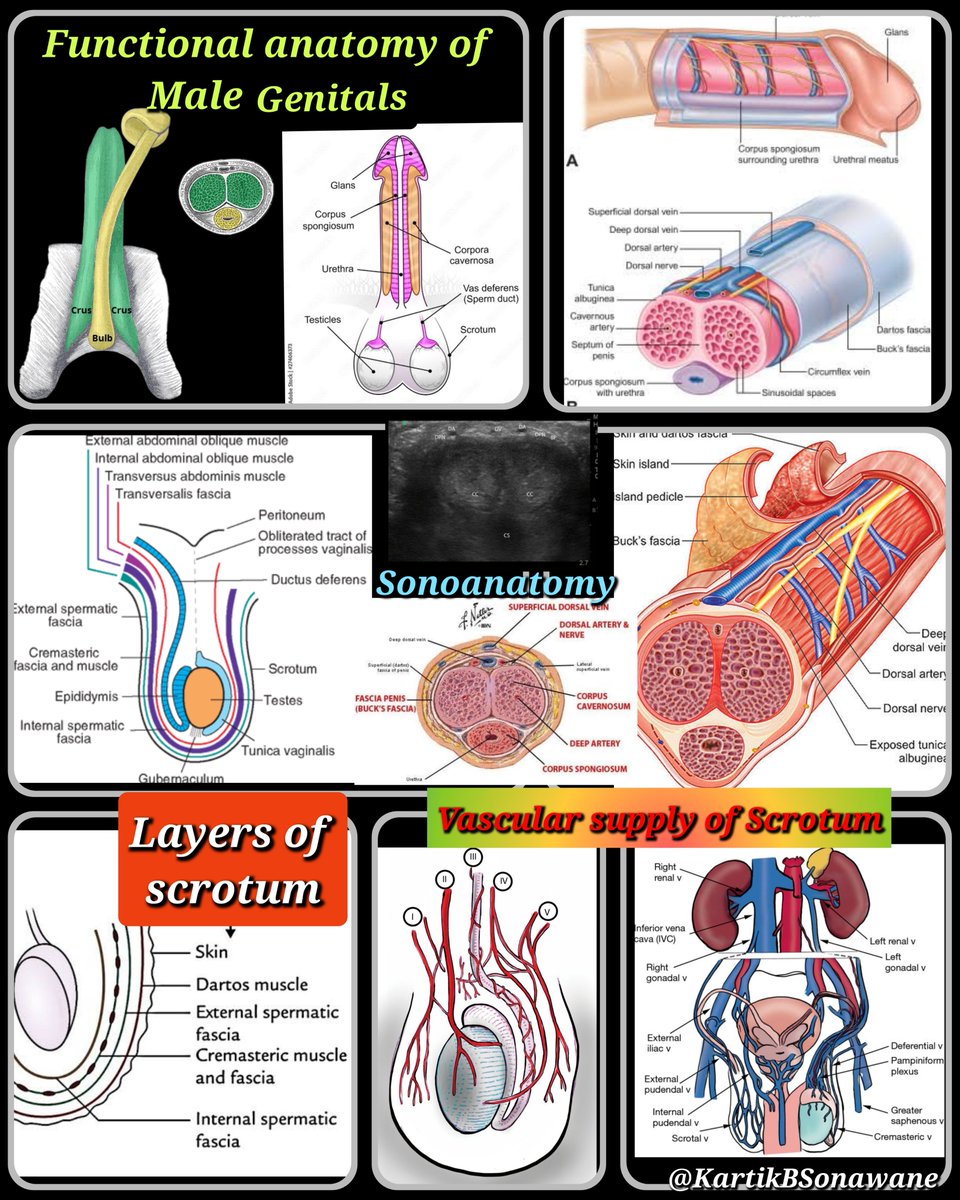 KartikBSonawane's tweet photo. "RA in Male genital Sx.:
Target spinal segments S2-S4 (for Penile Sx) & L1-L2 + S2-S4 (for Scrotal Sx)."
#RAingenitalsurgery #Penileblock #RAinpediatrics #RAinchildren #RAinscrotalsx #RAinUrogenitalSurgeries #pediatricRA
My 10 Points:
A. FUNCTIONAL ANATOMY:
1. PENIS is divided into 3 parts:
Root: Contains 3 erectile tissues (2 crura + 1 bulb) and 2 Ms. (Ishiocavernosus & Bulbospongiosus).
Body: Composed of 3 cylinders of erectile tissue: 2 corpora cavernosa and corpus spongiosum.
Glans: Most distal part, conical in shape, and formed by distal expansion of corpus spongiosum.
2. SCROTUM is pigmented external sac formed by skin + muscle that houses the testes, epididymis, and spermatic cord. The spermatic cord, a connective tissue matrix, contains vas deferens, 3 arteries, 3 veins, and 2 nerves. Third nerve (ilioinguinal N.) lies just lateral to the cord.
3. FASCIA:
Penile layers include -Skin, Superficial fascia (external fascia of Colles) is a continuation of Scarpa fascia; deep fascia (Buck’s fascia) is a continuation of deep perineal fascia, and Tunica albuginea (under Buck’s facia) forms an individual capsule around each cavernous body.
Scrotal layers include- Skin, superficial (Dartos) fascia, external spermatic fascia, cremaster muscle, internal spermatic fascia, and tunica vaginalis.
B. INNERVATIONS:
4. Penis: S2-S4 segments.
Sensory & Sympathetic innervation (skin + glans) Penis: Pudendal N. through Dorsal nerve of the penis (DNP) + Perineal nerves.
Encapsulated somatosensory receptors (mechanoreceptors/nociceptors) are present in prepuce.
Glans is innervated by free nerve endings and has protopathic sensitivity.
Parasympathetic: From the cavernous nerves from the peri-prostatic nerve plexus.
5. Scrotum & Testis: L1-L2 and S2-S4 (through IHG, IIN, GFN, and pudendal N).
Somatosensory: Anterolateral surface - Genital br. of GFN. Anterior surface - Anterior scrotal Ns. (br. of the IIN), Posterior surface- Posterior scrotal Ns. (from perineal N.), Inferior surface - Long scrotal br. (of PFCN).
Autonomic: Testes embryologically derived from the same level as the kidneys, so share common autonomic innervation.
90% Sympathetic from T10-L1 segments and 10% Parasympathetic from S2-S4.
Autonomic nerves (3 groups):
Superior spermatic Ns. (from renal & intermesenteric plexuses), Middle spermatic Ns. (from superior hypogastric plexus), Inferior spermatic Ns. (from inferior hypogastric plexus).
6. MYOTOMES:
Penile muscles (2 Bulbospongiosus + 2 Ishiocavernosus) : Deep branch of the perineal N. (branch of pudendal N).
Scrotal muscles (Dartos and Cremaster): Sympathetic and somatic fibres of the genital branch of GFN.
C. RA TECHNIQUES:
Target segments:
S2-S4: For all penile surgeries (Circumcision, hypospadias, urethroplasty, etc).
L1-L2, S2-S4: For all scrotal surgeries (Orchipexy, testis Sx, TURP etc)
7. Available RA techniques:
Caudal anesthesia -0.25-0.5 ml/kg LA volume (Lumbosacral segments). Associated with tachycardia, motor block of LL, and vomiting.
Topical analgesia using Lidocaine/Lidocaine + prilocaine.
Ring block – For analgesia. 8% failure rate, bleeding, and edema.
Penile block: Landmark-guided associated with swelling, hematoma/edema, or bruising. Ultrasound-guided is relatively safer.
8. Penile block (Landmark-guided):
Subpubic approach. Landmarks: Pubic symphysis & inferior border of the pubic rami.
2 needle entry points on lateral side of pubic symphysis, just below the pubic ramus (0.5 cm for babies and 1 cm for older boys).
Needle direction: Slightly medial & caudal direction (10-15 degrees to the vertical axis).
LA deposited- after a“POP” as the needle penetrates
Scarpas Fascia and enters into the subpubic space.
Coverage: DNP.
Sparing: Ventral penis, especially frenulum.
9. Penile block (USG-guided):
Probe kept transversely at the base of the penis between the shaft and the scrotum.
Sonoanatomy: Corpora cavernosa identified. Dorsal arteries, dorsal nerves, and dorsal vein are located beneath the deep fascia of the penis (Buck’s Fascia).
Standard 2-inj technique: LA injected laterally (0.1 ml/kg) to the penile A. inside Buck’s Fascia on each side.
Modified (by Suleman et al.) single inj. technique:
Needle: In-plane approach entering from the right side. After negative aspiration 0.15-0.25 ml/kg LA injected within the fascia around right DNP.
Needle slightly retracted under the corpora cavernosa. A 1-2 ml of LA deposited on the median line.
Needle was advanced towards the contralateral nerves and LA deposited under the fascia to block left DNP.
Advantage: Single entry needle with bilateral anesthesia of DNP + ventral glans. Circumferential spread of LA with anesthesia of the entire penis.
10. Supplementary RA techniques:
a) Ring block of penis:
Same cutaneous puncture as the dorsal block. Needle can be fanned out subcutaneously to the 3 and 9 o’clock position and then by repositioning the needle to these position to subcutaneous involve 6 o’clock/scrotal area.
b) Ilioinguinal + iliohypogastric nerves block:
Landmark-guided - Needle entry point 2cm medial and 2cm superior to the ASIS.
USG-guided: Probe is Kept obliquely on a line joining ASIS with umbilicus. Both nerves can be located between IOM-TAM with pulsating DCA adjacent to them.
c) Pudendal nerve block:
Landmark/PNS-guided- With the patient in the lithotomy, the ischial spine is palpated via transrectal (male) or transvaginal (female). LA deposition- Posterior to the ischial spine at the attachment of sacro-spinous ligament.
Ultrasound-guided: Pt in lateral decubitus position. Probe (curvilinear): Kept on the midpoint of the line connecting GT and PSIS. Sonoanatomy: Continuous hyperechoic line - iliac bone. The probe moved parallel and caudal to the lesser sciatic notch. Needle: 80-120 mm needle inserted in-plane from lateral-to-medial direction until tip located close to the pudendal A. Pudendal N. stimulation - Paresthesia in the perineum. LA volume: 15-20 ml LA.