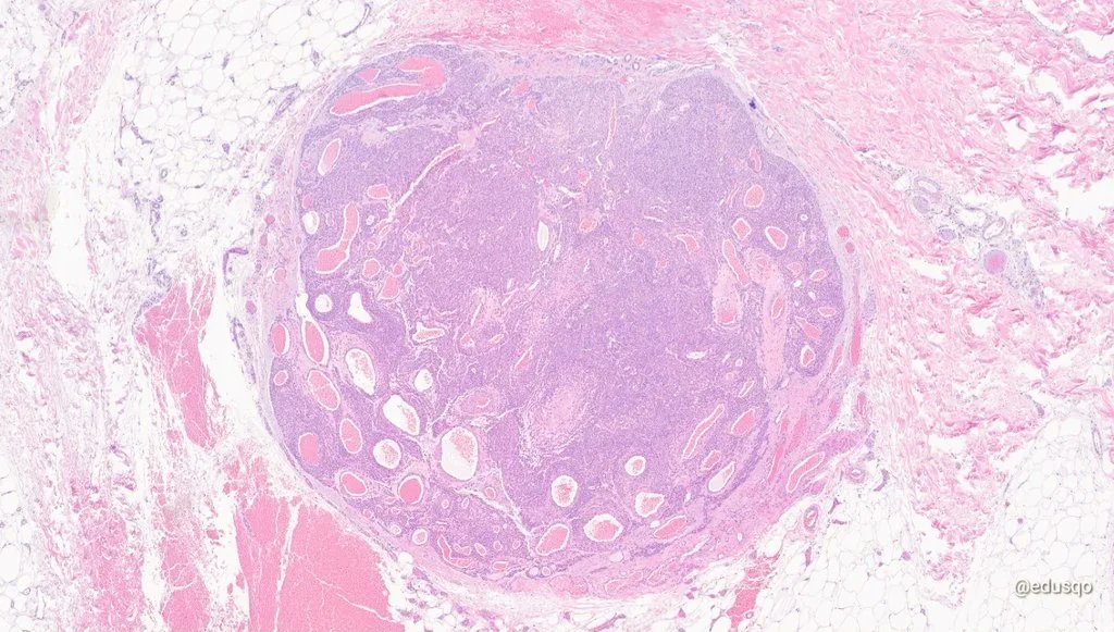 edusqo's tweet photo. Stop looking at me, glomus! 🤨
I'm just doin' my job.
It is your fault for growing in that patient and being so painful.
#DermPath #ItsYouNotMe https://t.co/kYmtlk4Tsm
