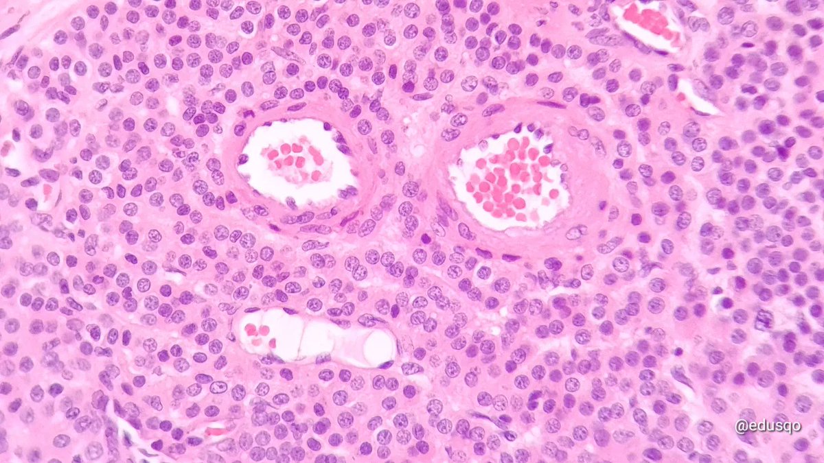 edusqo's tweet photo. Stop looking at me, glomus! 🤨
I'm just doin' my job.
It is your fault for growing in that patient and being so painful.
#DermPath #ItsYouNotMe https://t.co/kYmtlk4Tsm