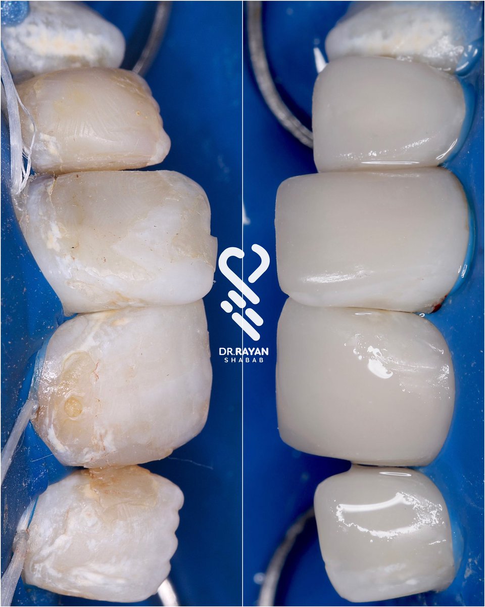 dr_ryn7's tweet photo. ✨🪄 حـشـوات فـقـط .
Direct Composite Restorations 🎨💙

@laser_dentc https://t.co/MON77q9Wbc