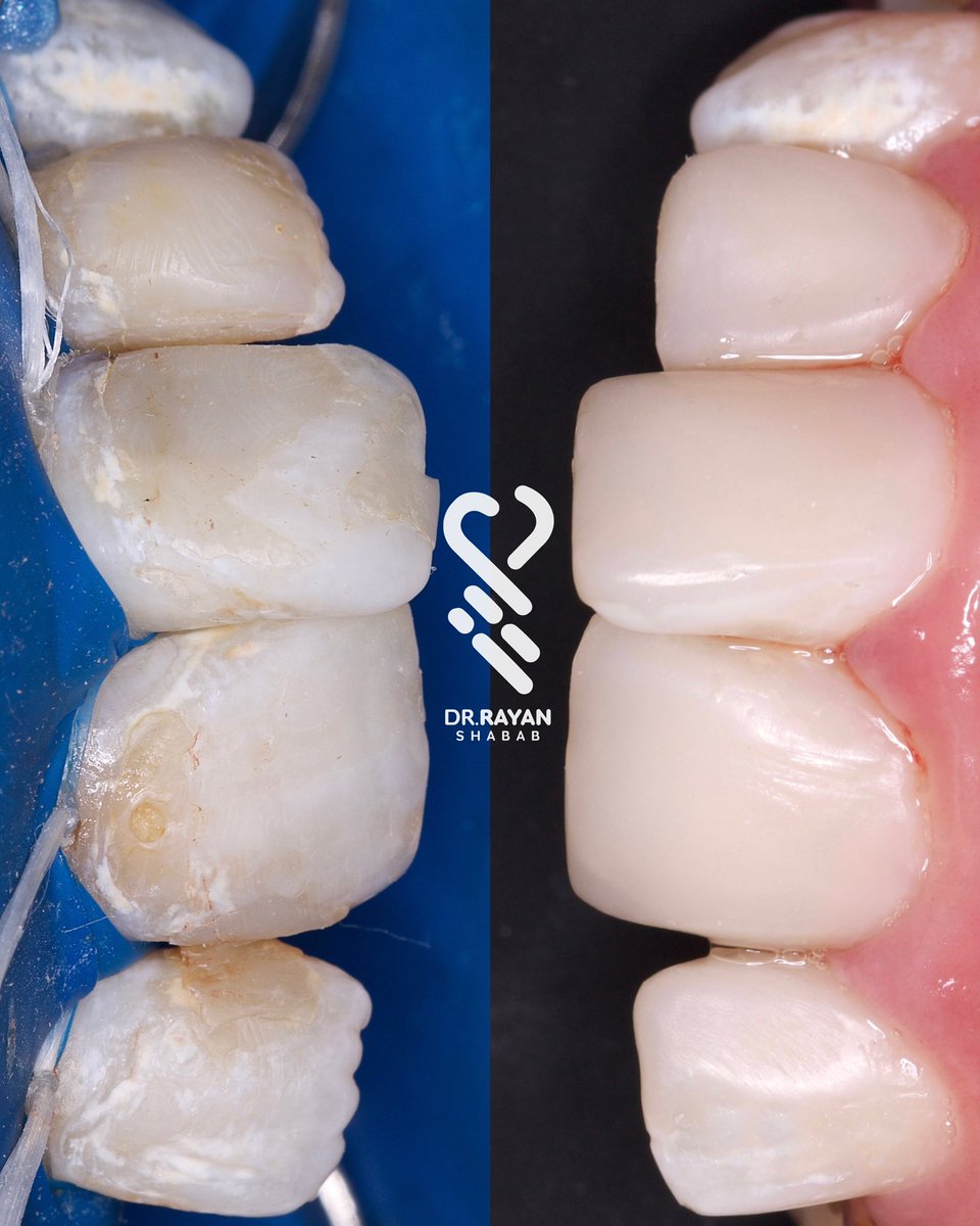 dr_ryn7's tweet photo. ✨🪄 حـشـوات فـقـط .
Direct Composite Restorations 🎨💙

@laser_dentc https://t.co/MON77q9Wbc