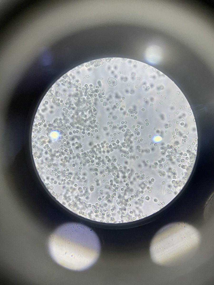 sp0Emma's tweet photo. Urine sample for female patient 
>100 pus , bacteria , mucus threads https://t.co/VhYnzvYguM