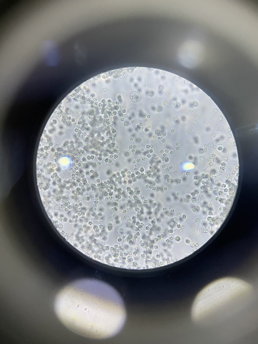 sp0Emma's tweet photo. Urine sample for female patient 
>100 pus , bacteria , mucus threads https://t.co/VhYnzvYguM