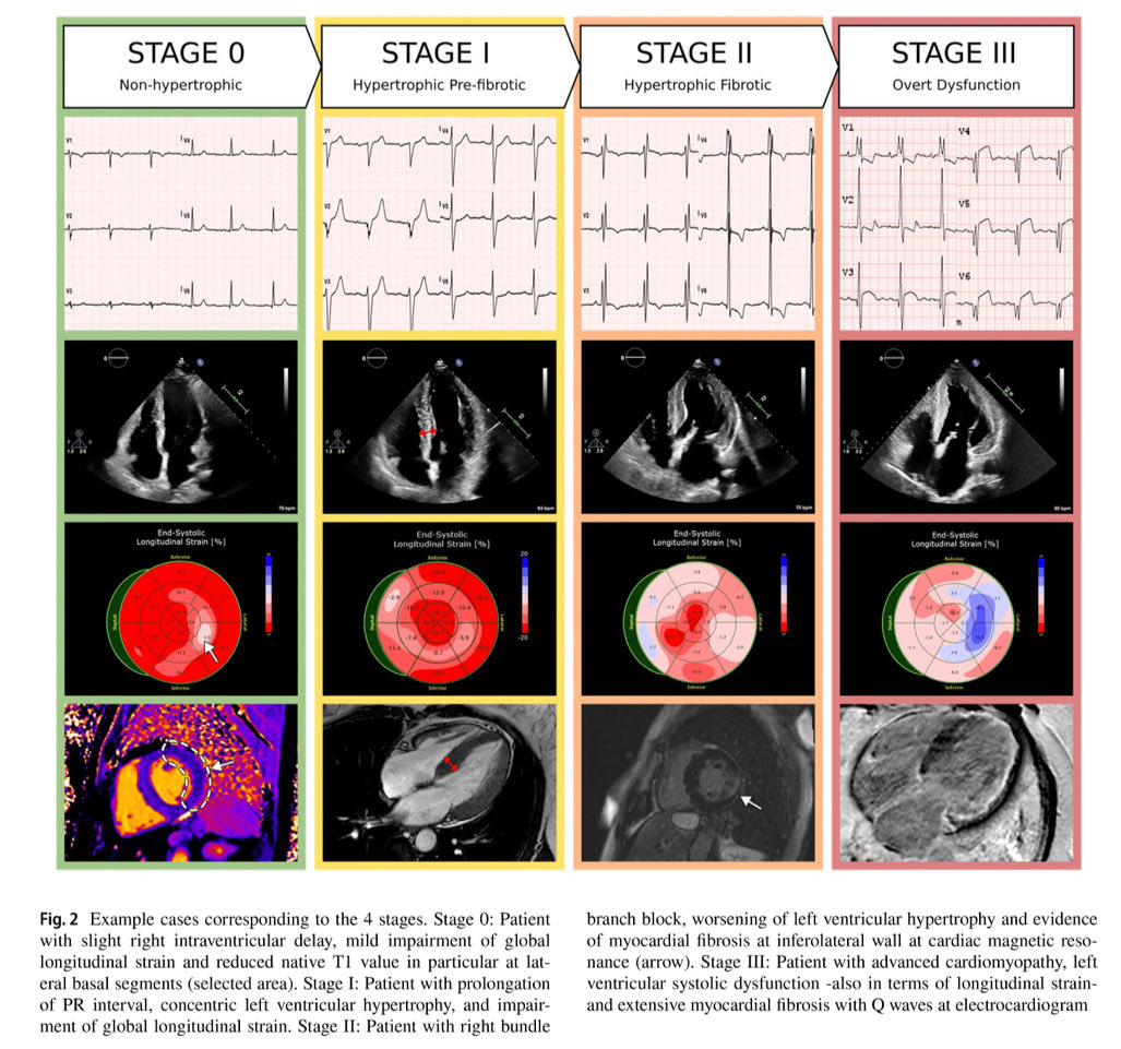🔴 Clinical staging of Anderson-Fabry cardiomyopathy: An operative proposal #CardioEd #Cardiology #cardioTwitter #fabry