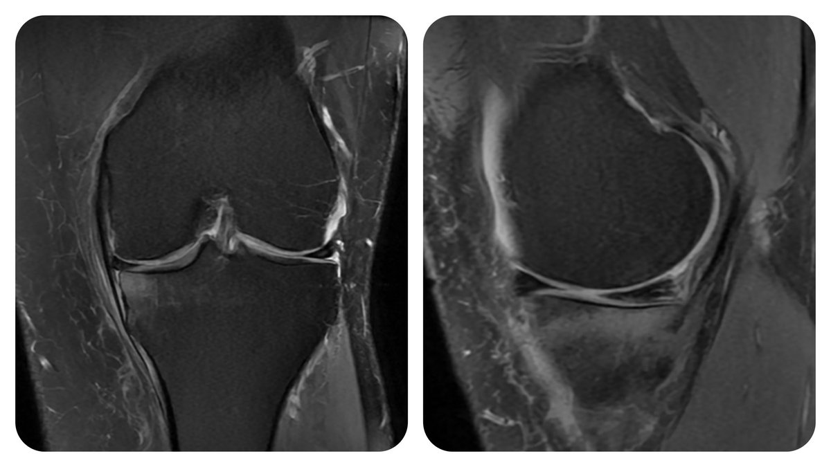 47yo, medial knee pain 
BMI 41.5
He lives in 🇺🇸 
3 ortho there recommended UKA
None talked about weight loss and exercise 
WHAAAAAAT?? 🤯🤯🤯