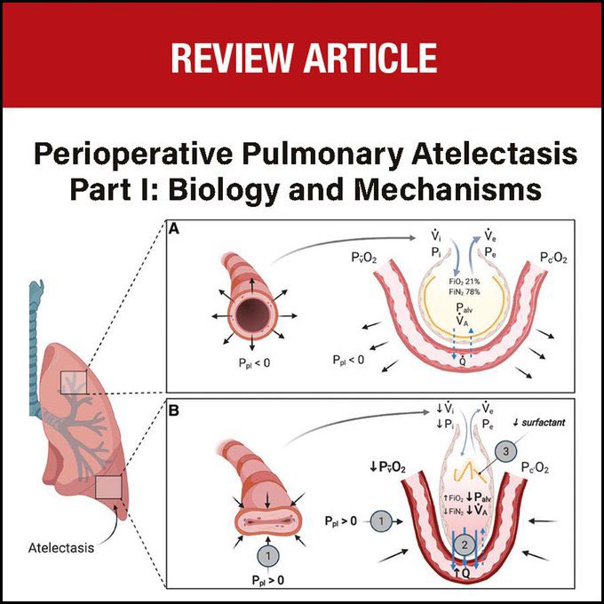Atelectasias Posoperatorias 🔪 🫁 Review del @_Anesthesiology Imperdible: ow.ly/vWe550Qlweh