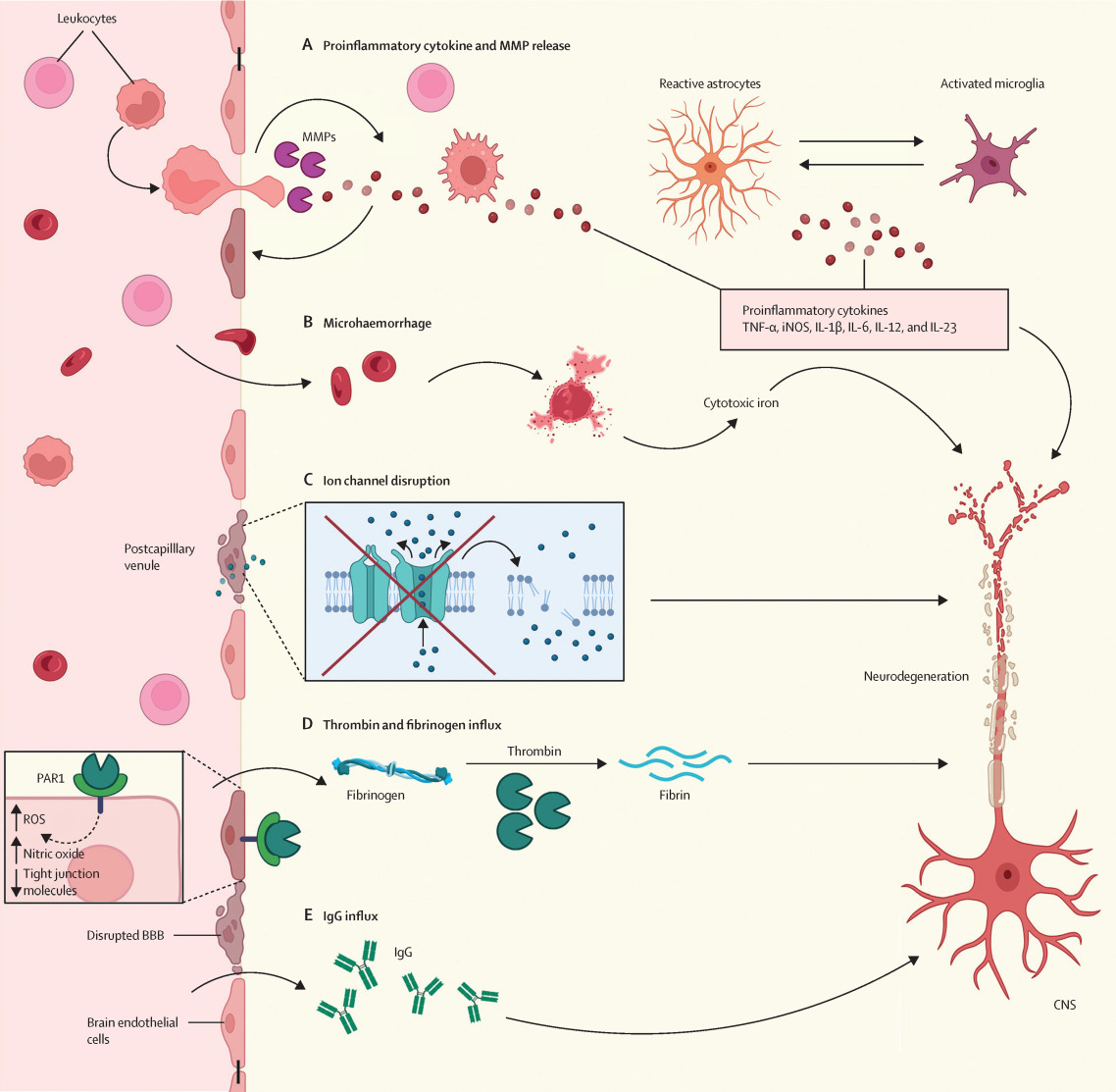 Comprehensive and insightful review by @PratLab discussing the role of genes & environment on BBB disruption in MS and the therapeutic implications of mesenchymal stromal cells and antibodies targeting cell adhesion molecules or #fibrin to halt neurodegeneration. @TheLancetNeuro…