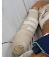 TERRIBLE
Jesús de 12 años perdió su mano (no se encontró la extremidad) y lo peor; que no puede ver, lesionados ambos ojos puede quedar ciego. LE EXPLOTÓ UNA CAMARETA. Ocurrió en la Juan Montalvo, norte de Guayaquil.