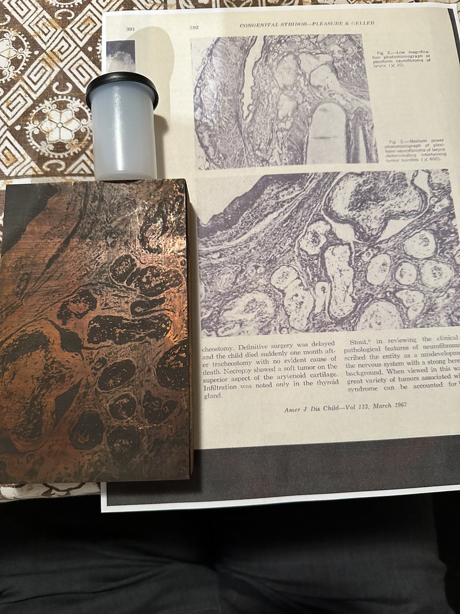 sanamloghavi's tweet image. To all privileged academics, myself included: next time we complain how hard it is 2 publish:👇🏼how #pathologists 📷 🔬 cases, ref’d w/ #indexmedicus & managed 2 publish anyway
talking 2 those of us @paperpile ing away in #Googledocs & our fancy e-📷🔬
courtesy of Dr. S. Geller