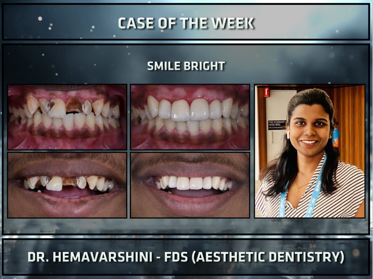 Case of the week - Smile Bright #dentistry #Esthetics #Smile