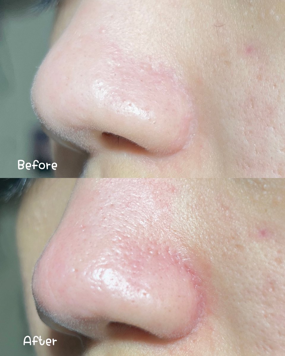 เครื่องดูดสิวเสี้ยนอันนี้แบบสะใจมากก ปรับระดับได้ด้วย แต่เราใช้แค่ Low ก็ดูดแบบถอนรากละ แล้วเขามีหลายหัวด้วยนะ มีหัวที่ใช้สำหรับซอกจมูกได้ด้วย ใครสิวเสี้ยนเยอะไปตำ shope.ee/30NyB7g5Vk 💖