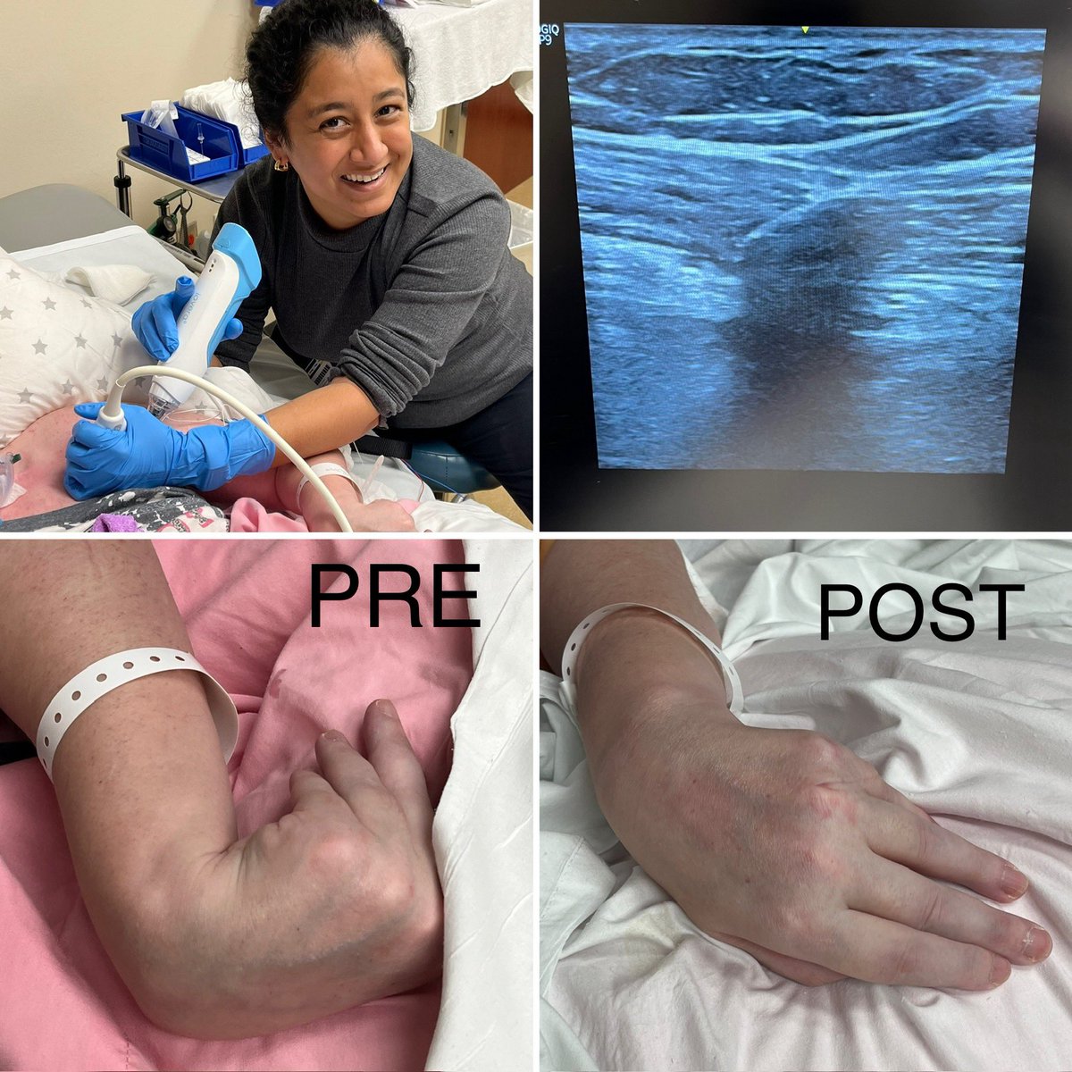 #spasticity case of the Day! #BIM fellow Dr Tulsi Pandat did her first 3 cases of #cryoneurolysis today with great success!! @UTHPMR #physiatry