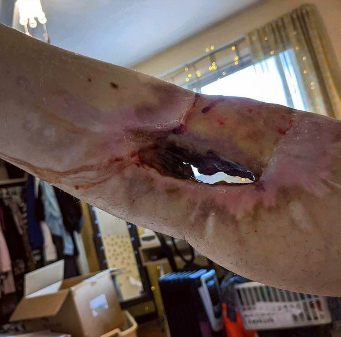 chroniclzofs's tweet photo. warning: very graphic images

differentiallykelly's legs before amputation. read her story if you think this isn't real https://t.co/gyBZFVqC2h