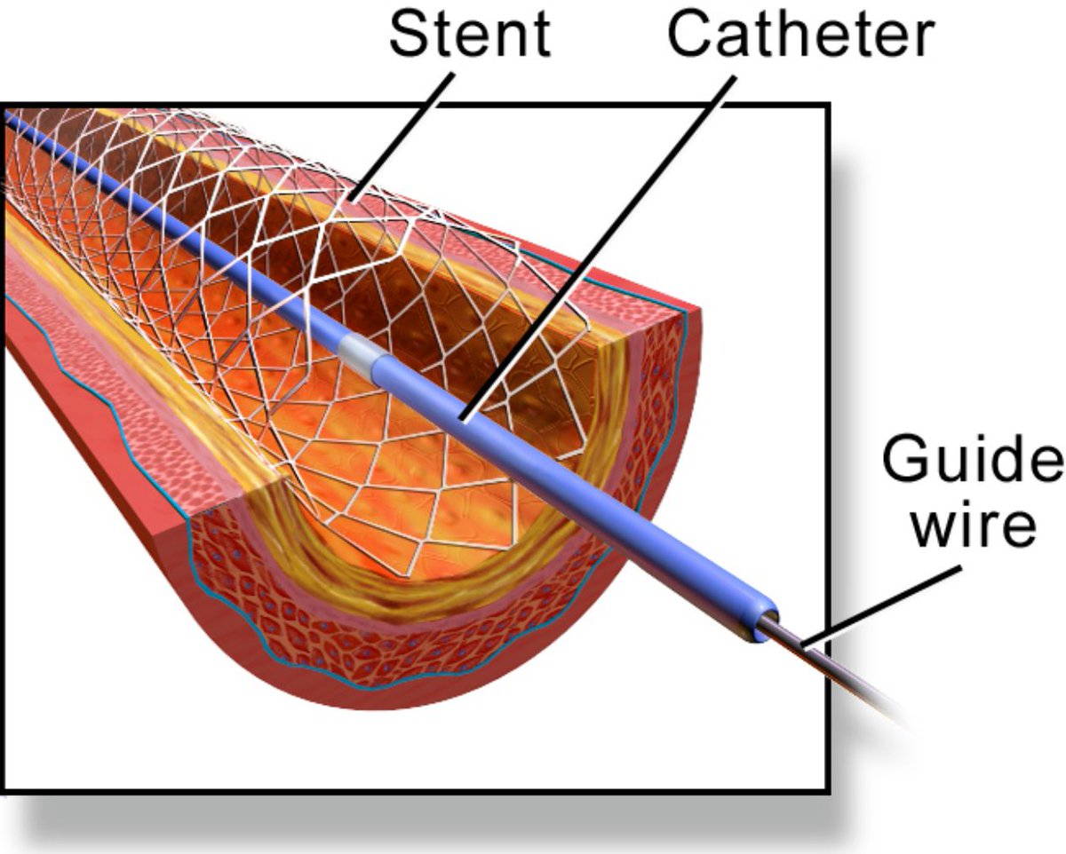 PhD alert @KingsImaging! 'Blood flow dynamics assessment distal to knee and hip arteries stented with the Supera stent' With a dream supervisory team joining academic, clinical and industrial forces Start: 1st June Deadline: 15th Feb Apply: kcl.ac.uk/study-legacy/f…