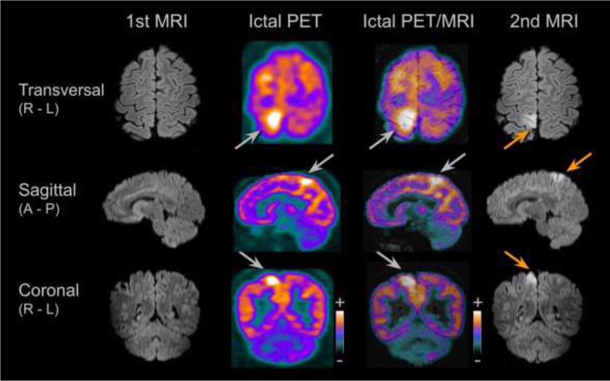 ClinNuclearMed's tweet photo. Current Issue: Early Positive Brain 18F-FDG PET and Negative MRI in Rasmussen Encephalitis https://t.co/XuKuKekifR https://t.co/SS8W1SOaNx