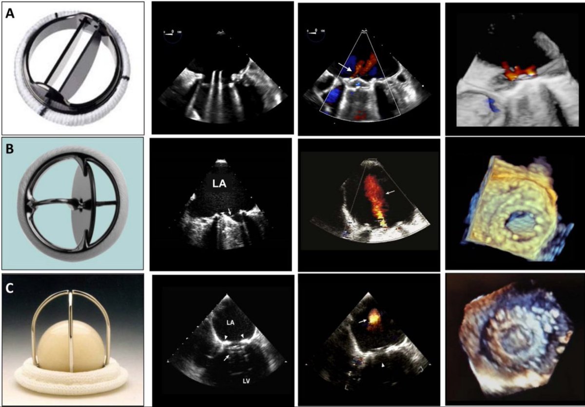 MAecocardio's tweet photo. Nuevas guías valoración prótesis con técnicas de imagen .!comienza bien el año¡ https://t.co/bzBimJyga0 https://t.co/D21cs3XrTh