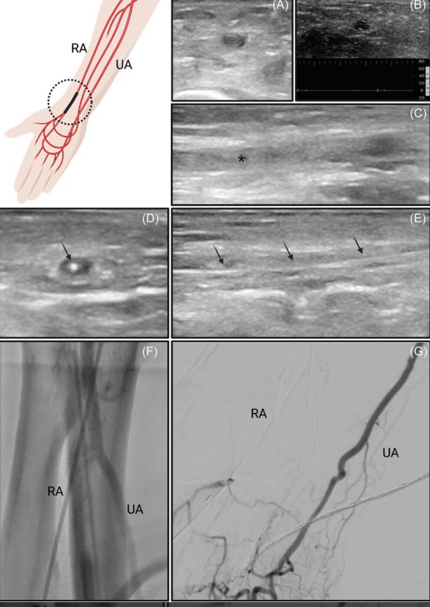 FRANCESCO BURZOTTA (@burzotta_f) on Twitter photo #Angiography or #echofirst to guide #radialfirst cardiovascular procedures? <a href="/bianchinifra92/">Francesco Bianchini</a> et al. nicely described OUR COMBINED APPROACH in <a href="/ccijournal/">CCIjournal</a> … according to our daily practice, very smooth way to increase radial access successes. onlinelibrary.wiley.com/doi/full/10.10… #Angiography or #echofirst to guide #radialfirst cardiovascular procedures? <a href="/bianchinifra92/">Francesco Bianchini</a> et al. nicely described OUR COMBINED APPROACH in <a href="/ccijournal/">CCIjournal</a> … according to our daily practice, very smooth way to increase radial access successes. onlinelibrary.wiley.com/doi/full/10.10…
