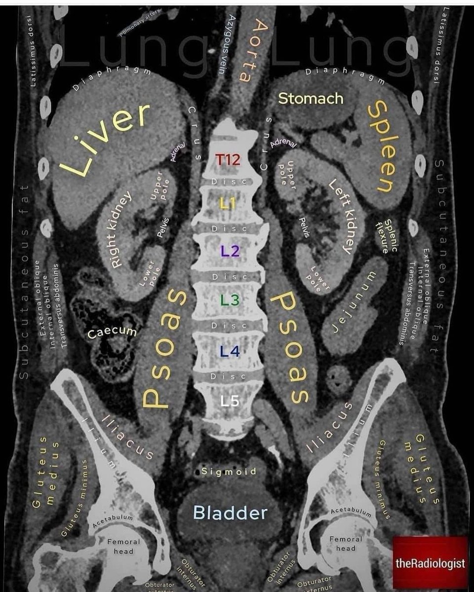 Real Ct Scan Ct Scan Abdomen Anatomy Startradiology
