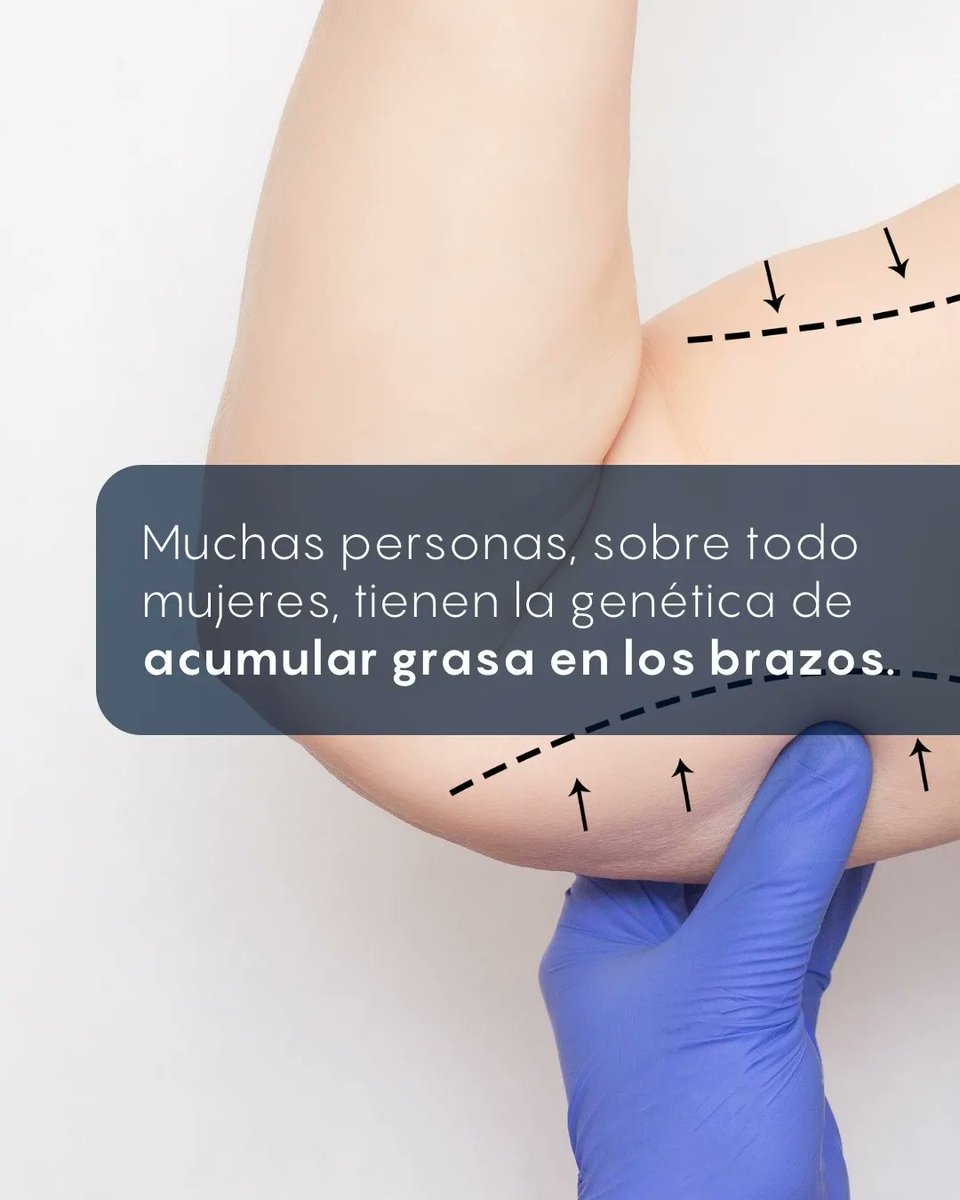 SPACPRE's tweet photo. ✅ Hoy conocé más acerca de la liposucción de brazos ☝🏻

Te recordamos la importancia de acudir a un cirujano plástico certificado ✨
 
Cuida tu vida ♥️

#lipodebrazo
#liposucciondebrazos https://t.co/A0FlKeDk7Q