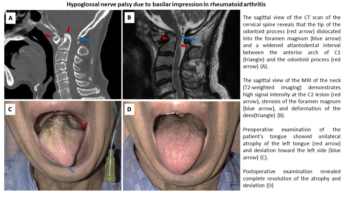 Hypoglossal nerve palsy due to basilar impression in #RA 👉rdcu.be/du8WR Basilar impression: ✅serious complication of RA ✅ tip of the odontoid process migrates upward into the foramen magnum ✅due to the weakening of supporting connective tissue and bony structures