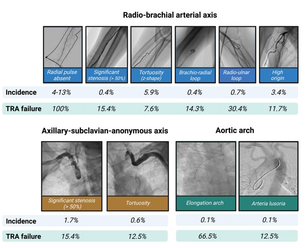 Stefano Migliaro (@stefano_mig) on Twitter photo Great paper about radial access by my friend <a href="/bianchinifra92/">Francesco Bianchini</a> and the expert Prof. <a href="/BURZOTTA_F/">FRANCESCO BURZOTTA</a>
Very instructive read with high profile images; thank you for these advice! onlinelibrary.wiley.com/doi/full/10.10… Great paper about radial access by my friend <a href="/bianchinifra92/">Francesco Bianchini</a> and the expert Prof. <a href="/BURZOTTA_F/">FRANCESCO BURZOTTA</a>
Very instructive read with high profile images; thank you for these advice! onlinelibrary.wiley.com/doi/full/10.10…