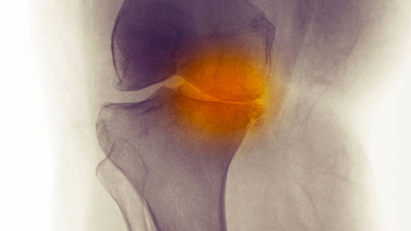 Check out our latest #collection of articles on #osteoarthritis, discussing the latest insights into its #pathogenesis and #management go.nature.com/45N4HTs