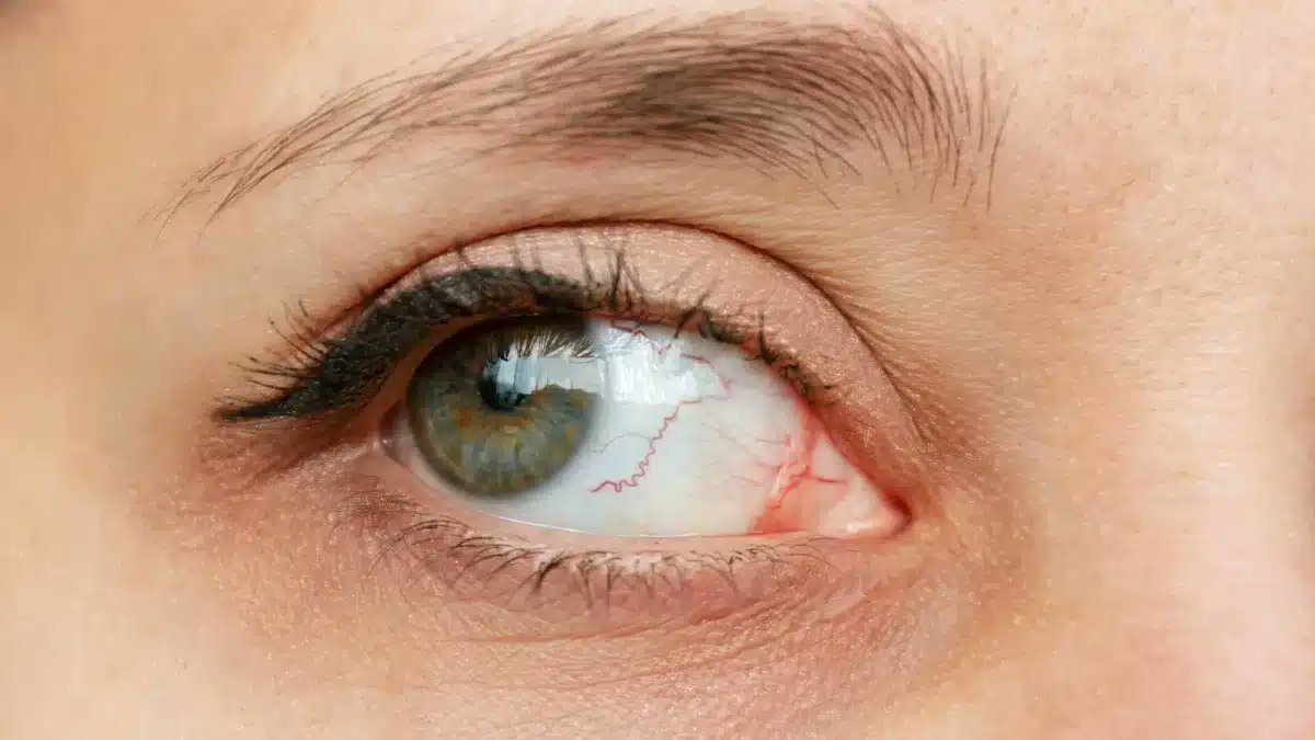 GoodRxMedicine_'s tweet photo. Learn about the causes of keratitis and understand corneal inflammation in our comprehensive guide 👁️
https://t.co/mbSQFlcudP
#eyecare https://t.co/JY4XGNLllX