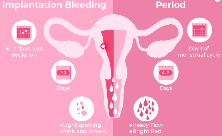 JObstetrics's tweet photo. Implantation bleeding can occur about 10-14 days after conception when the fertilized egg attaches to the interior lining of the uterus.
Visit us for more information: https://t.co/ZiuIzHuMbe
#implantation #bleeding #fertilized #eggs #pregnant #women #menstrual https://t.co/xRolKva0ng