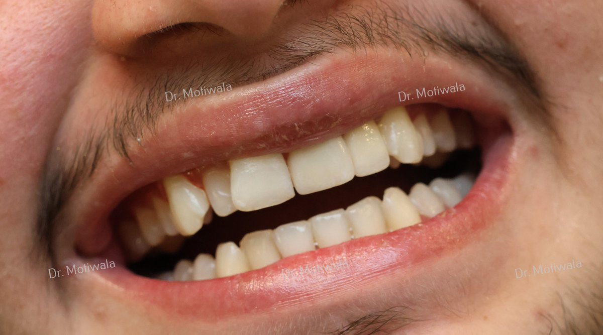drmotiwaladcic's tweet photo. Restoration of a Fractured Central Incisor case
An immediate-loading, single-piece implant was used to replace the removed central incisor. Zirconia crown was placed, this treatment was completed in 3 days.
https://t.co/YnHwGzQEv9
#zirconiacrown #fracturedtooth #basalimplants https://t.co/360WfwDVTz