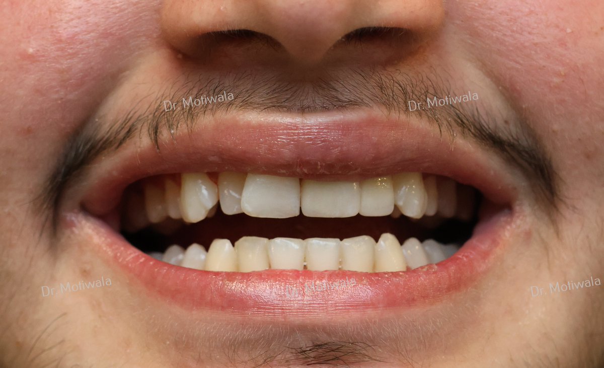 drmotiwaladcic's tweet photo. Restoration of a Fractured Central Incisor case
An immediate-loading, single-piece implant was used to replace the removed central incisor. Zirconia crown was placed, this treatment was completed in 3 days.
https://t.co/YnHwGzQEv9
#zirconiacrown #fracturedtooth #basalimplants https://t.co/360WfwDVTz