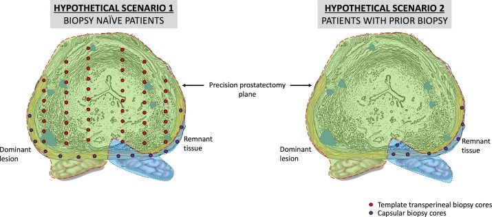 Throwback Thursday: The Precision Prostatectomy: “Waiting for Godot” buff.ly/393A3Y7 @DrFAbdollah @urojeong @MMenonMD #throwbackthursday #UroSoMe #Medtwitter