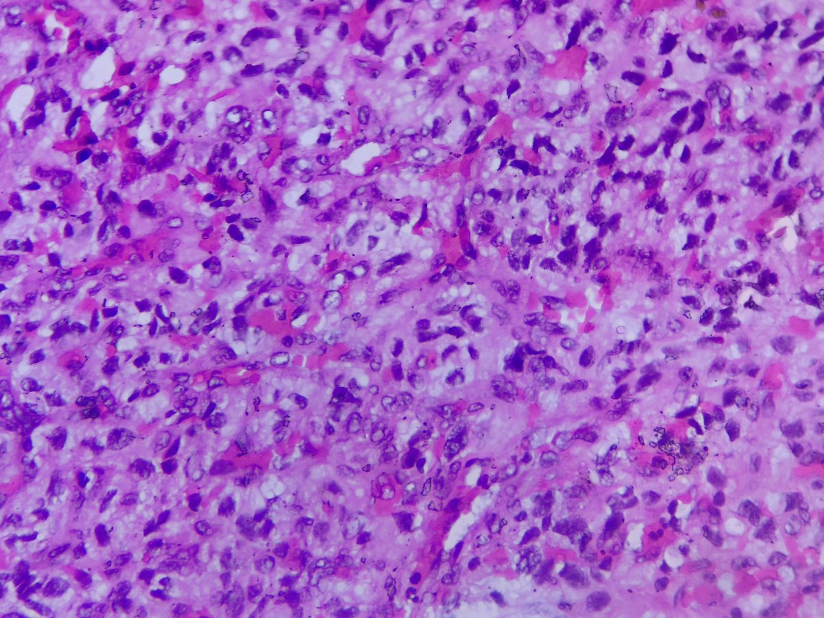 🧔🏻‍♂️Middle aged
🔙Previously operated for RCC
🆕Presents with ataxia
MRI :intracranial SOL (🔬)
Which IHC would stain the stromal cells here?

#pathX #pathTwitter #neuropath #pathquiz #ihcpath