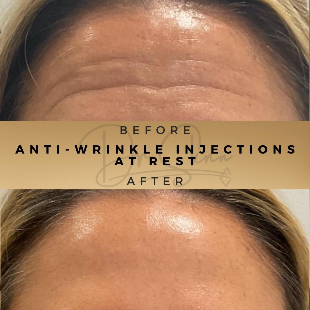Forehead Anti-Wrinkle Injections Botox Results Dr Sknn, Wilmslow

#AntiWrinkleInjections #Botox #CosmeticInjections #SkinRejuvenation #AestheticMedicine #AntiAgingTreatment #YouthfulSkin #ForeheadWrinkles #WrinkleTreatment #BotoxTreatment #FacialRejuvenation #AgeDefying #DrSknn